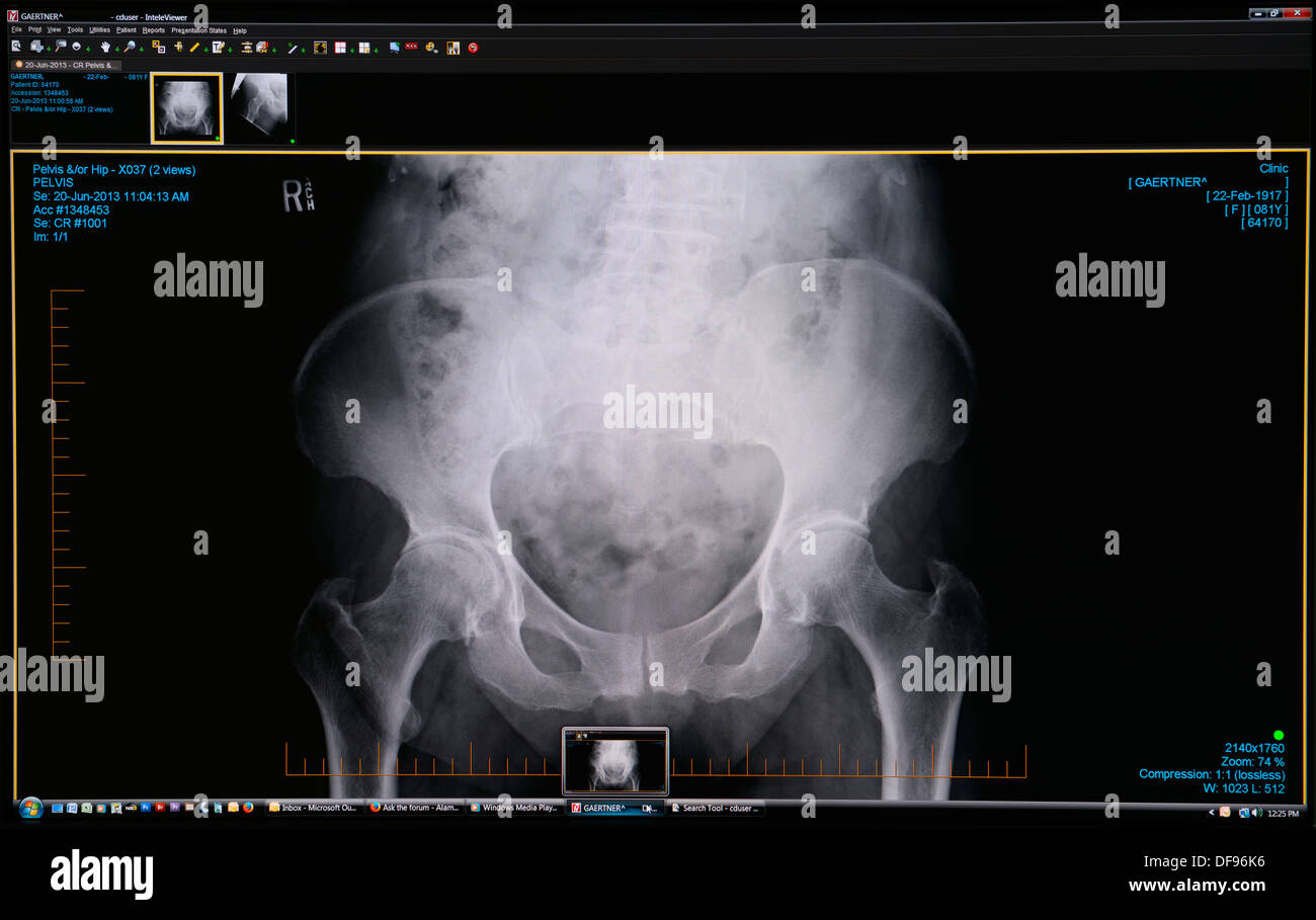 Computer screen shot di un medico diagnostico hip scansione a raggi X dell'immagine che mostra i giunti che necessitano di chirurgia di sostituzione Foto Stock