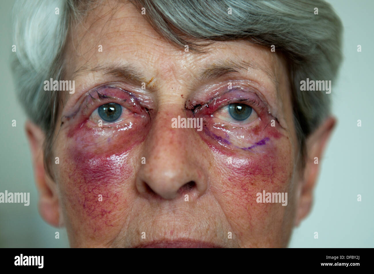 Elevatore della palpebra Foto Stock