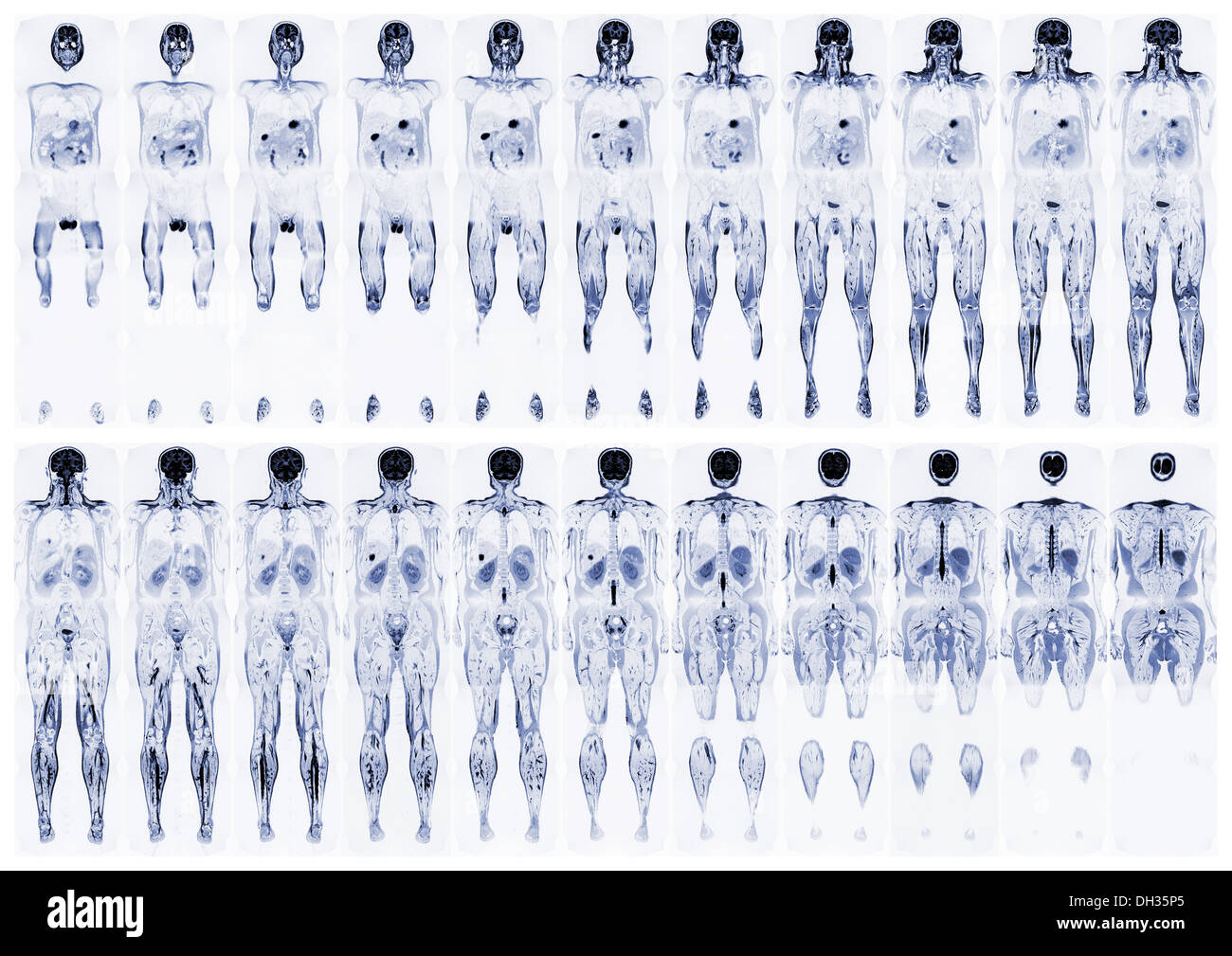 Reale completa scansione MRI del corpo umano, dalla parte anteriore e posteriore Foto Stock