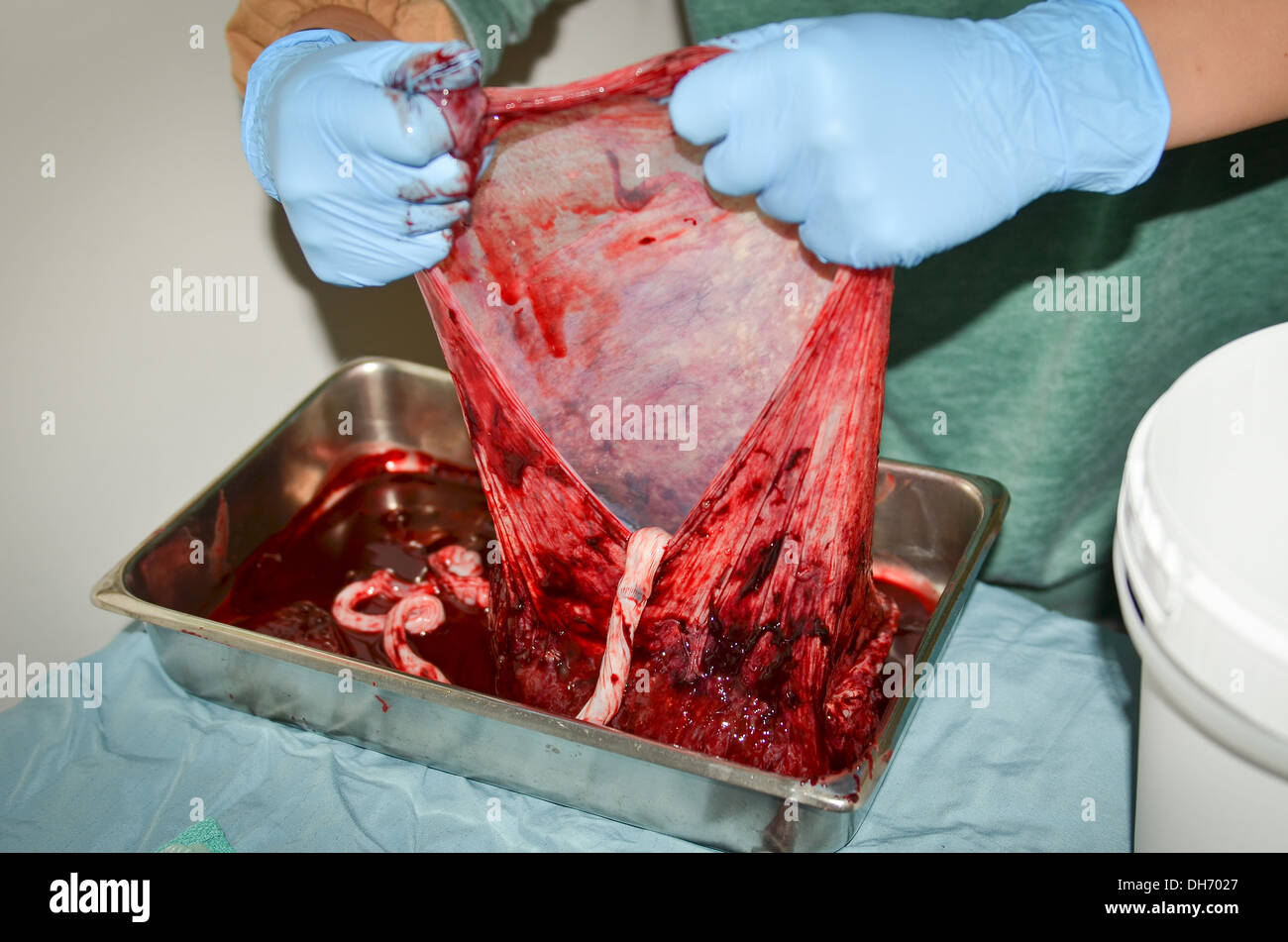 La placenta umana aperta tesa a svelare a sacco interno Foto Stock