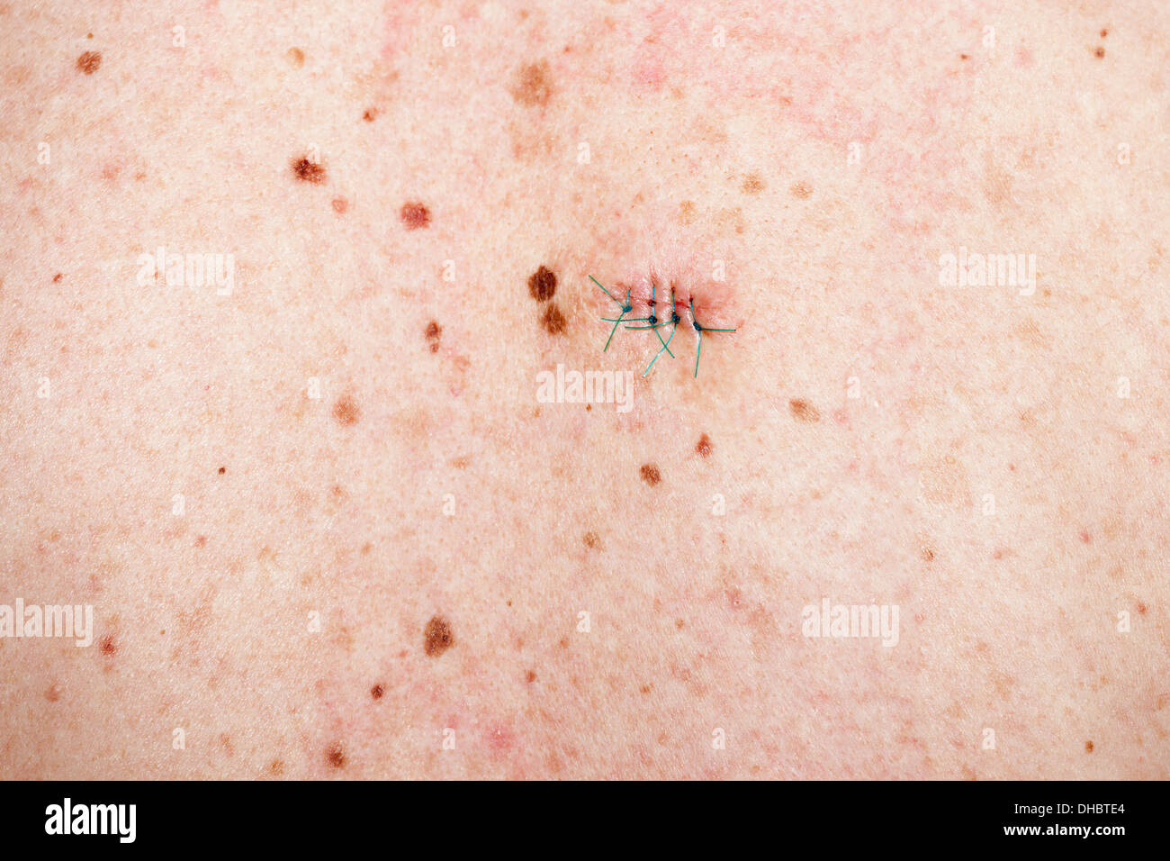 La pelle umana con cuciture - un sacco di moli, macchie e cicatrici da tagliare le verruche. Foto Stock