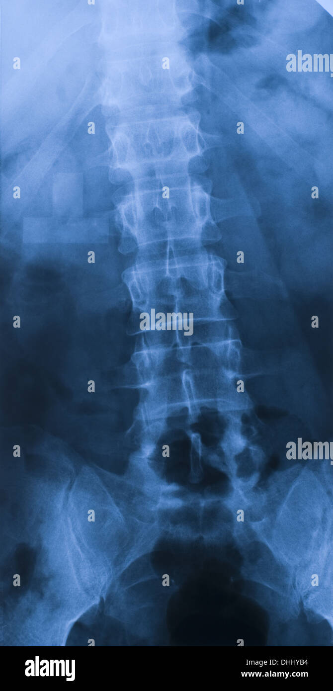 X ray di colonna vertebralis con Os sacrum Foto Stock