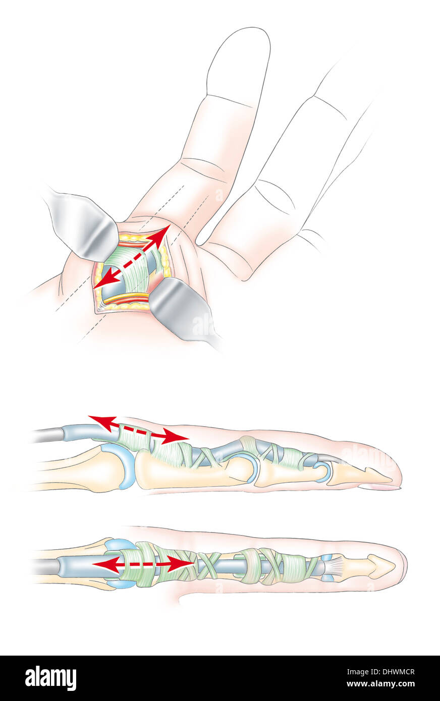 Chirurgia della mano, illustrazione Foto Stock