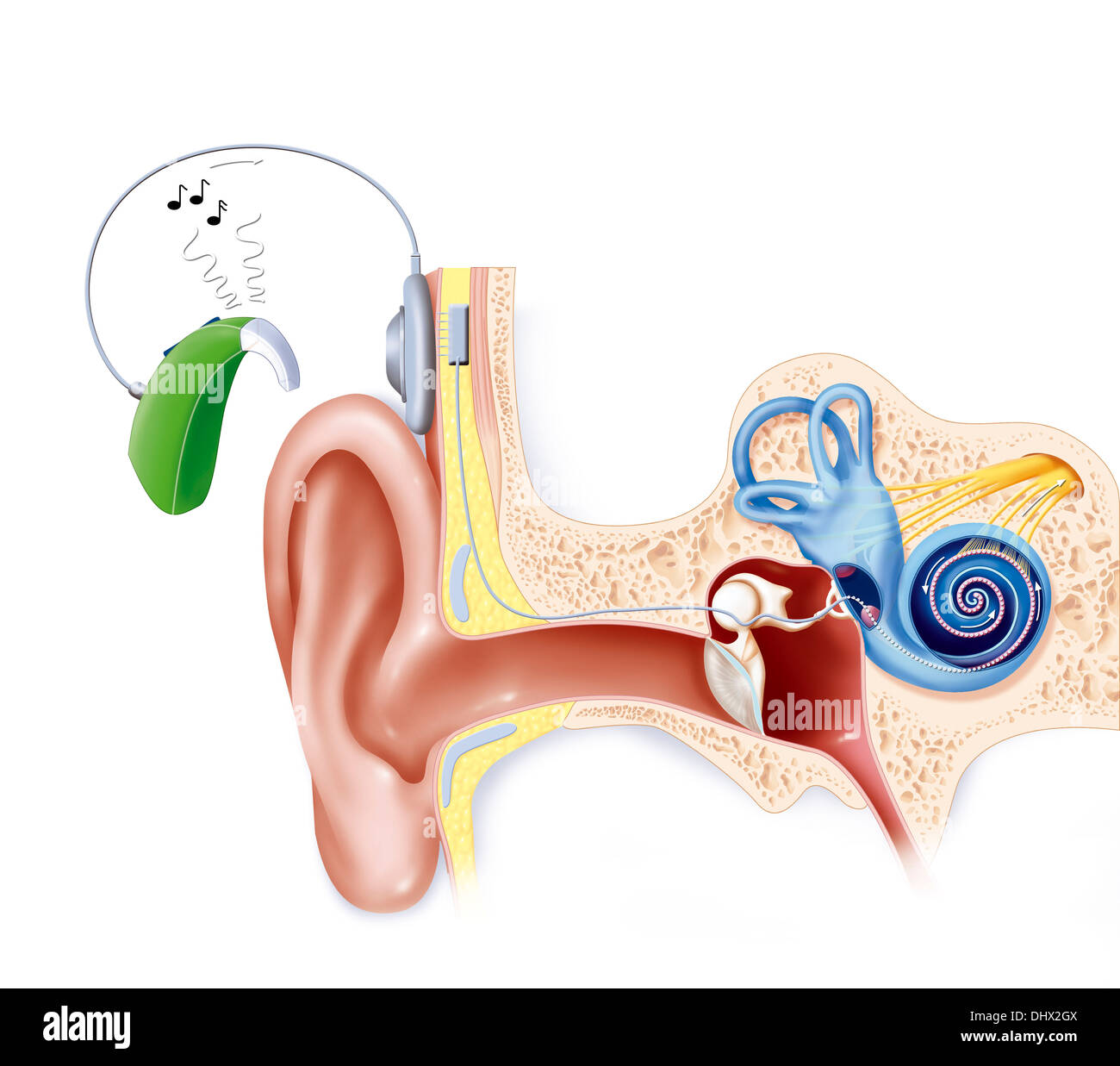 Cochlear immagini e fotografie stock ad alta risoluzione - Alamy