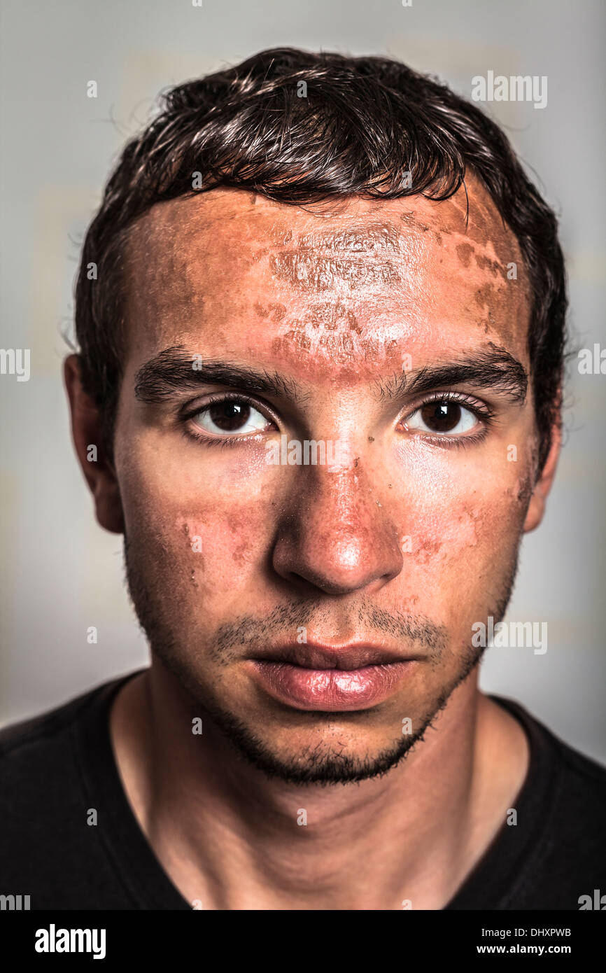 La scottatura peeling della pelle sul viso maschile causata dalla prolungata esposizione a luce diretta del sole. Foto Stock