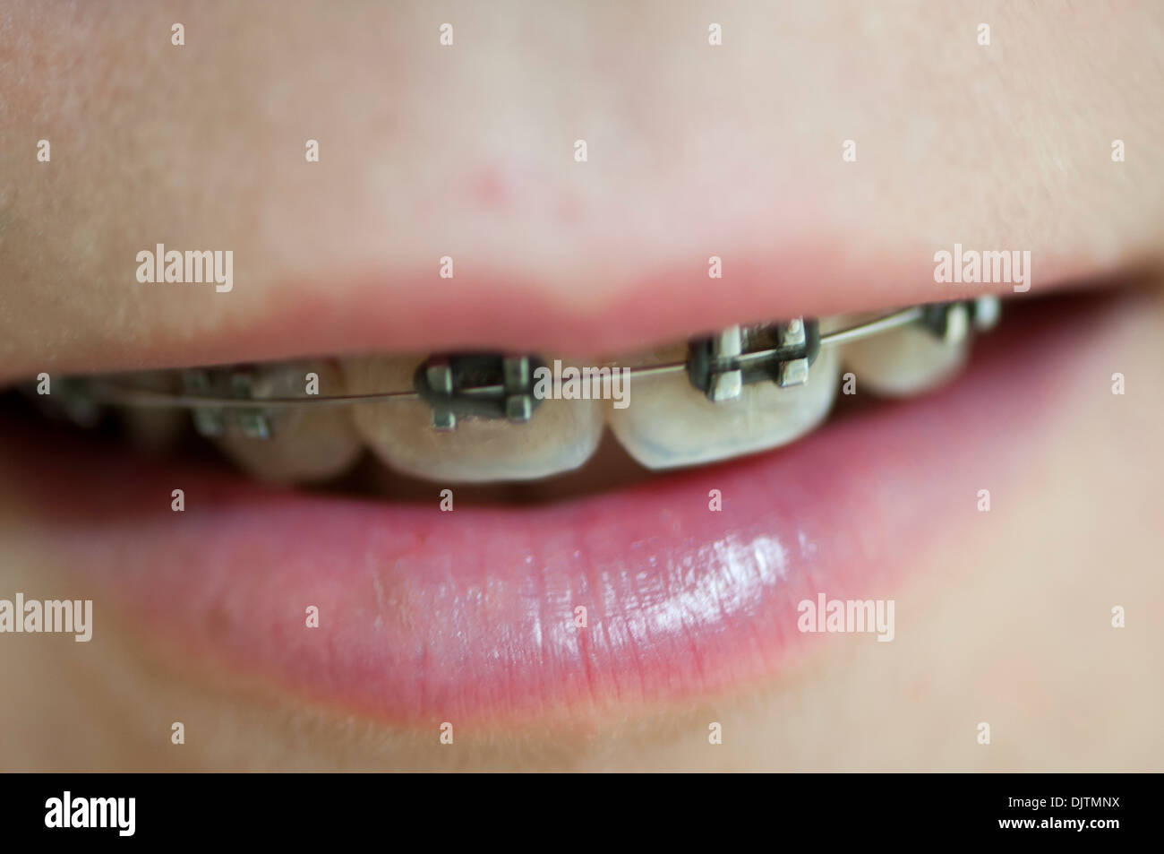 Bocca dove ci sono apparecchi ortodontici sui denti Foto Stock