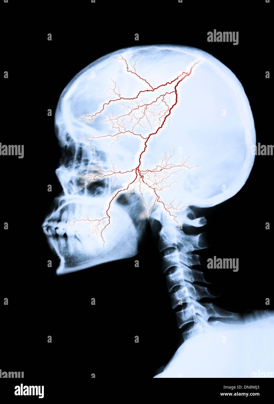 Immagine a raggi X di una testa umana con un fulmine nel cranio. Foto Stock