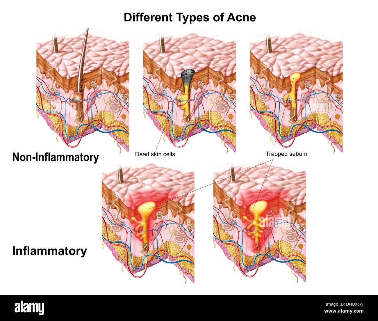 I diversi tipi di acne, non infiammatorio e infiammatorie. Foto Stock