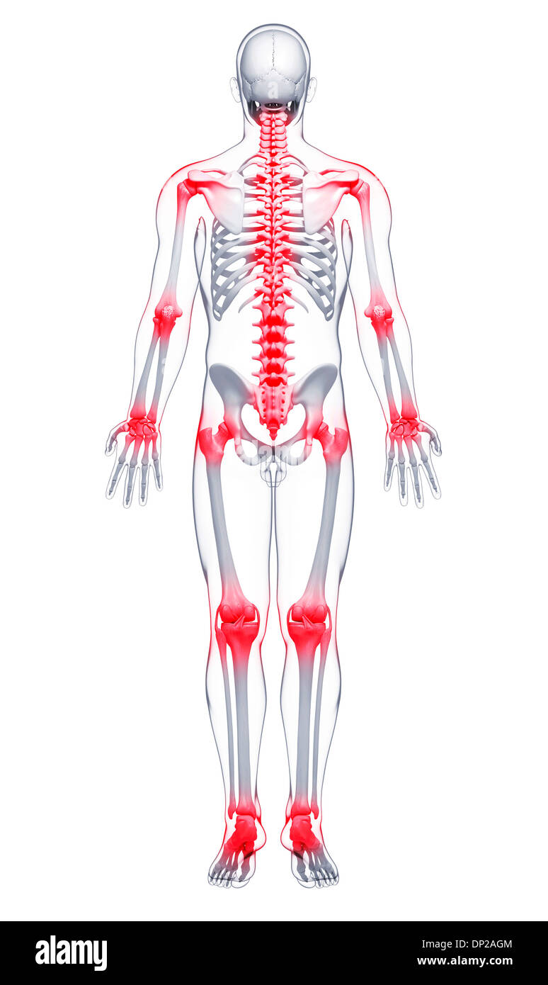 I dolori articolari, artwork Foto Stock