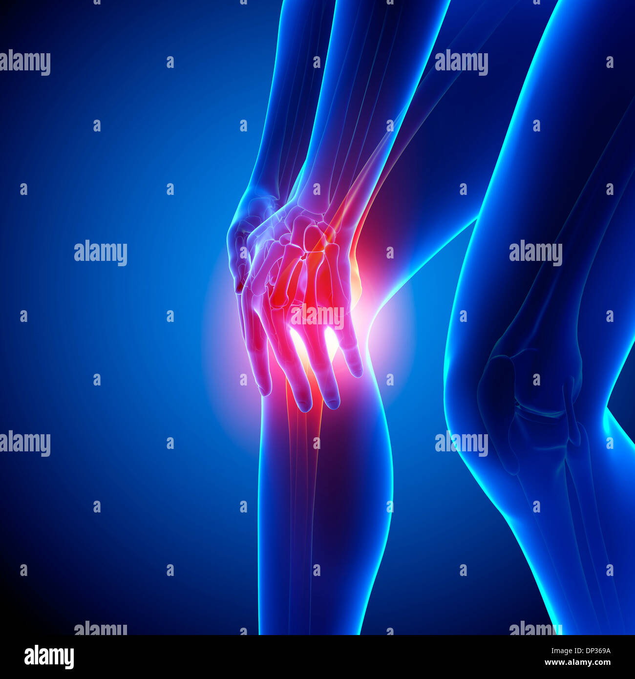 Il dolore al ginocchio, artwork Foto Stock