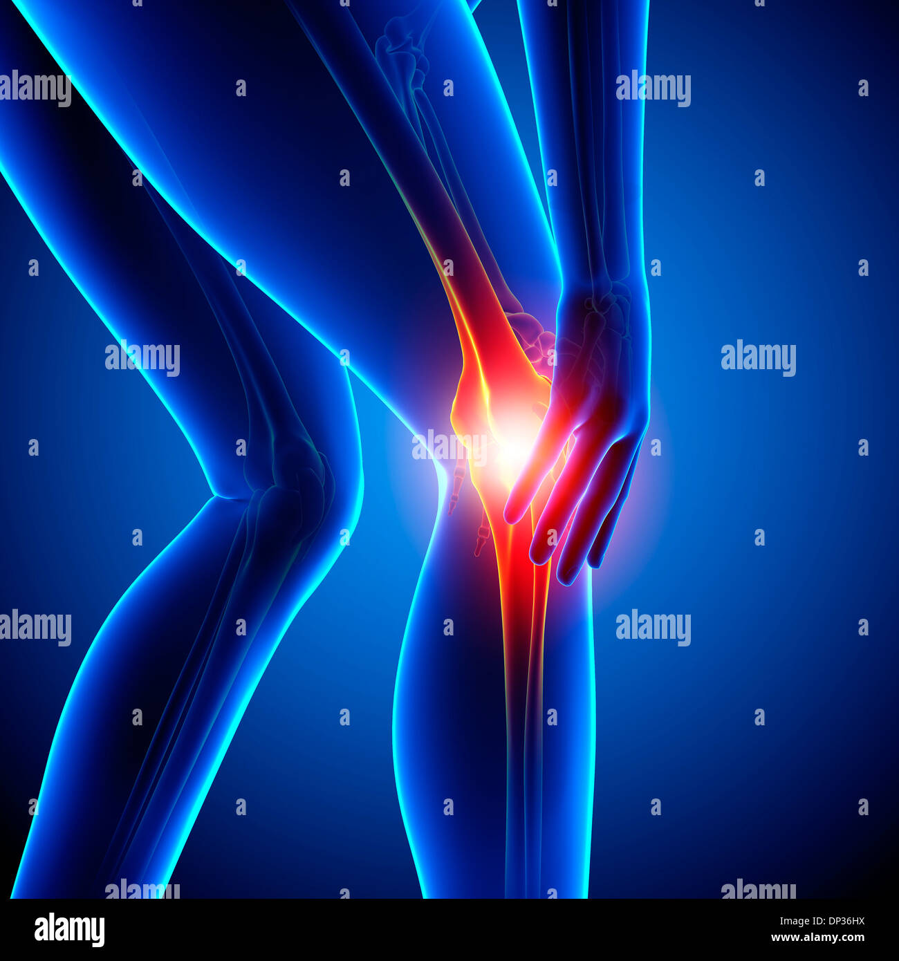Il dolore al ginocchio, artwork Foto Stock
