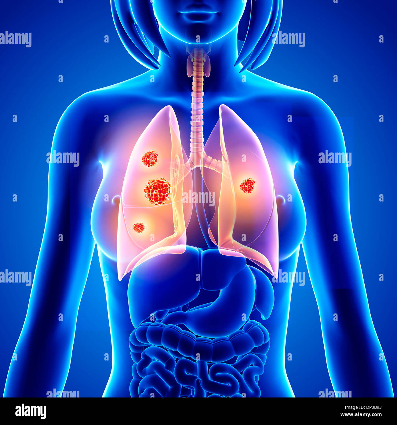 Il cancro del polmone, artwork Foto Stock