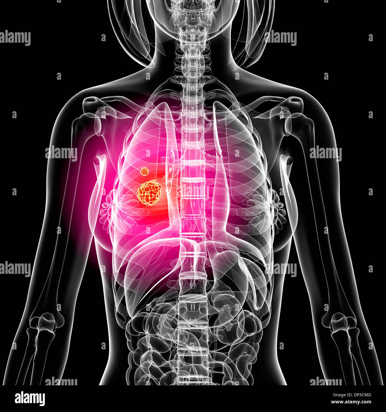 Il cancro del polmone, artwork Foto Stock