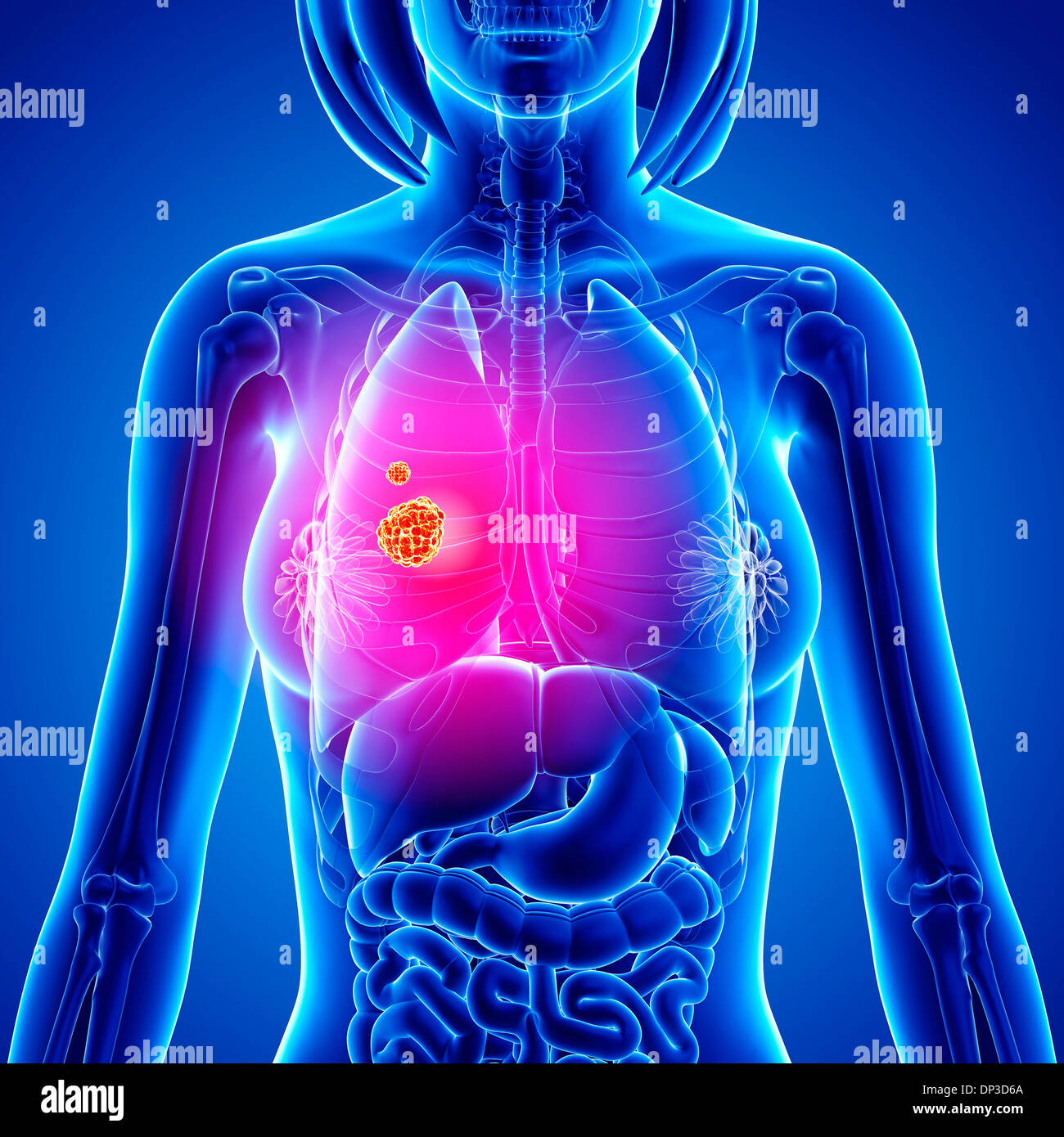 Il cancro del polmone, artwork Foto Stock