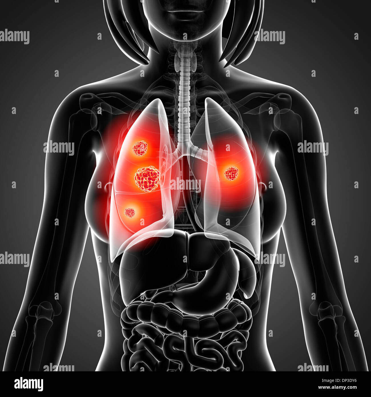 Il cancro del polmone, artwork Foto Stock