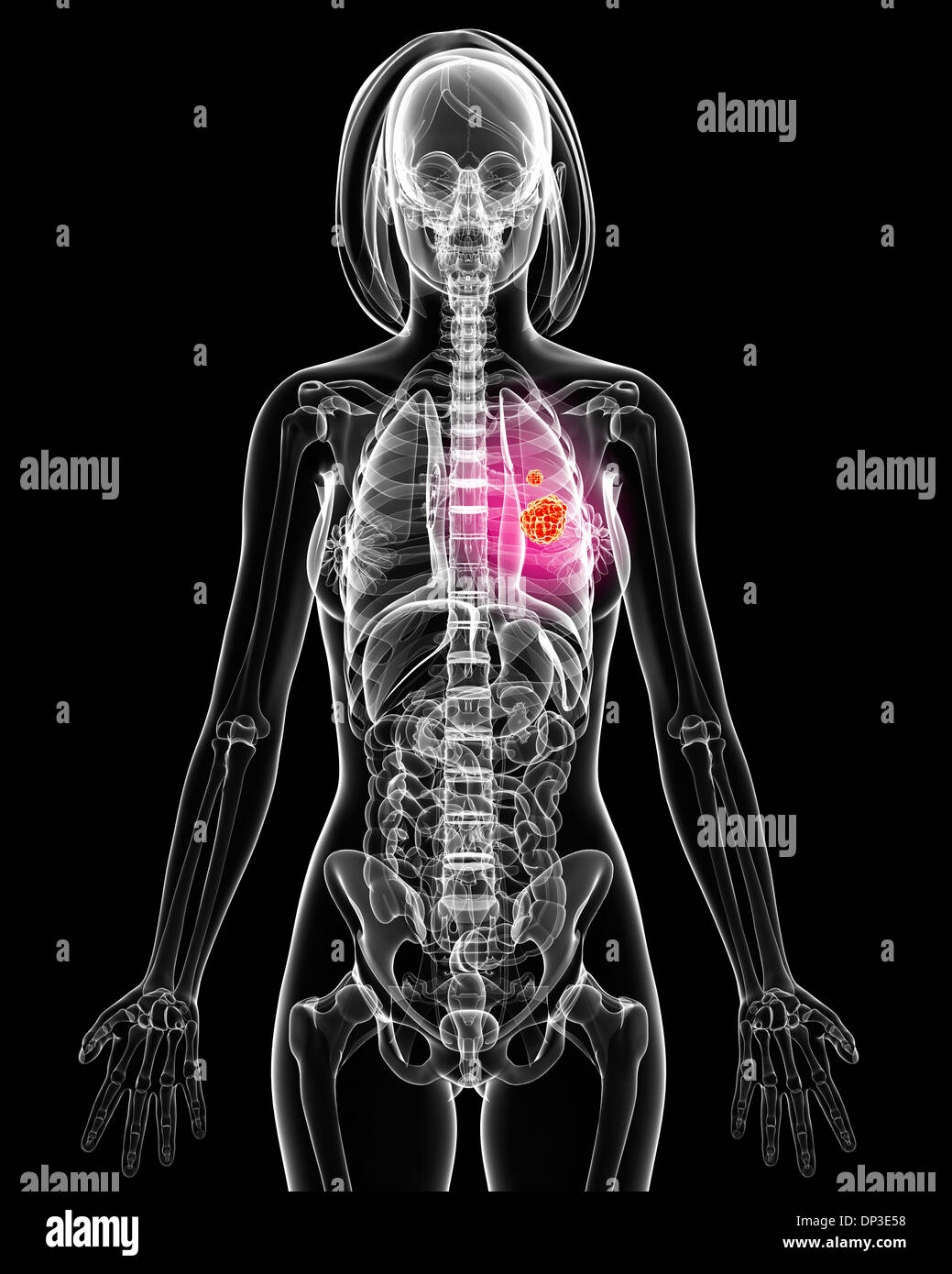 Il cancro del polmone, artwork Foto Stock