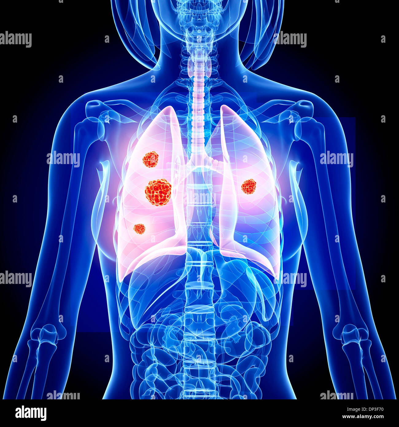 Il cancro del polmone, artwork Foto Stock