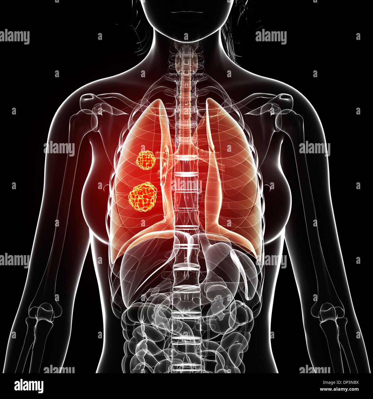 Il cancro del polmone, artwork Foto Stock