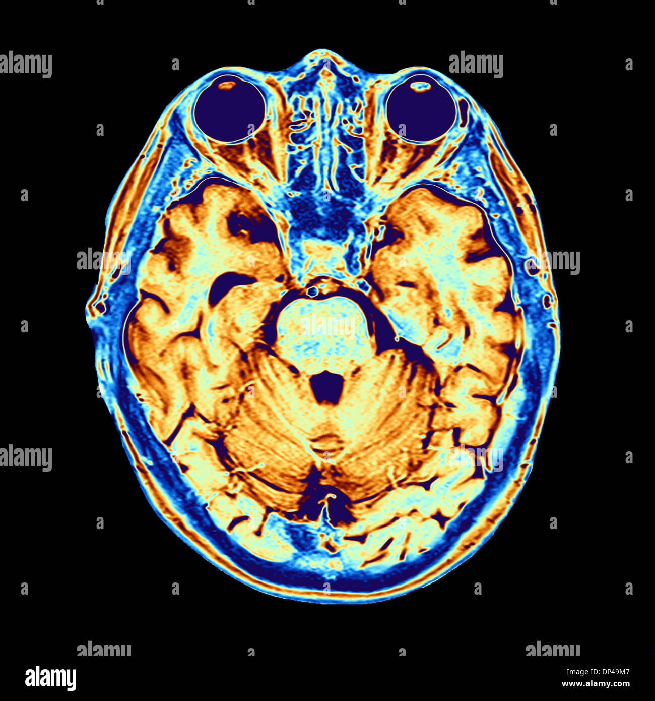 Colore scansione MRI della testa umana Foto Stock