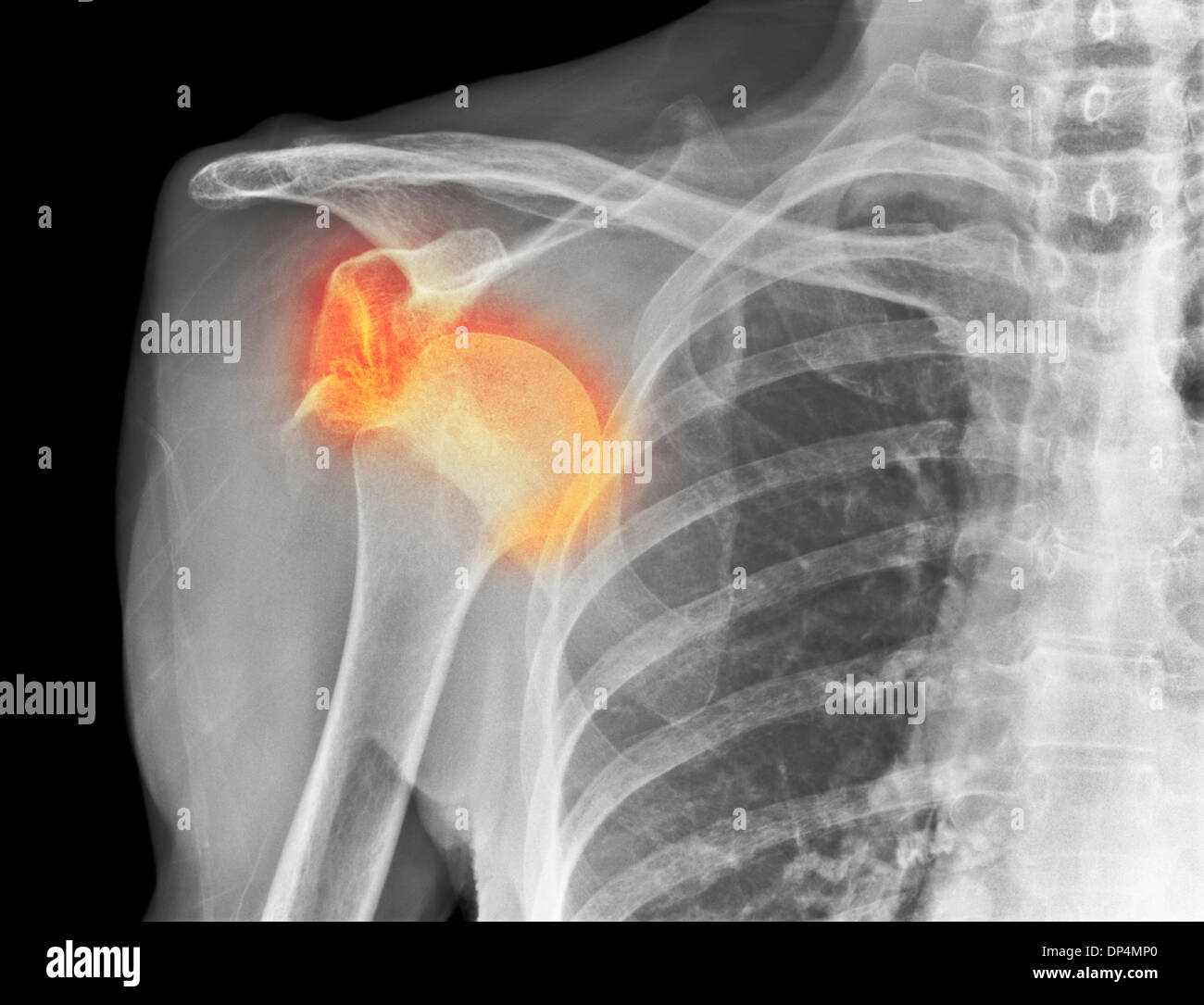 Spalla slogata, X-ray Foto Stock