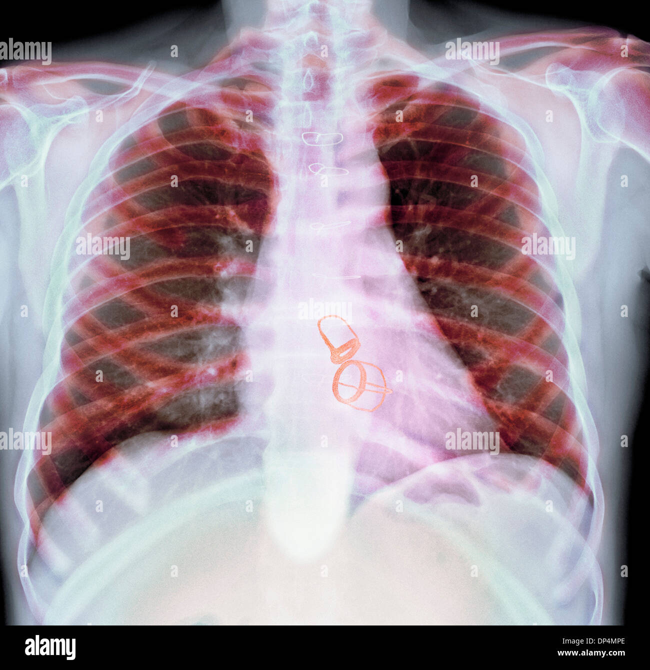 Valvole cardiache protesiche, X-ray Foto Stock