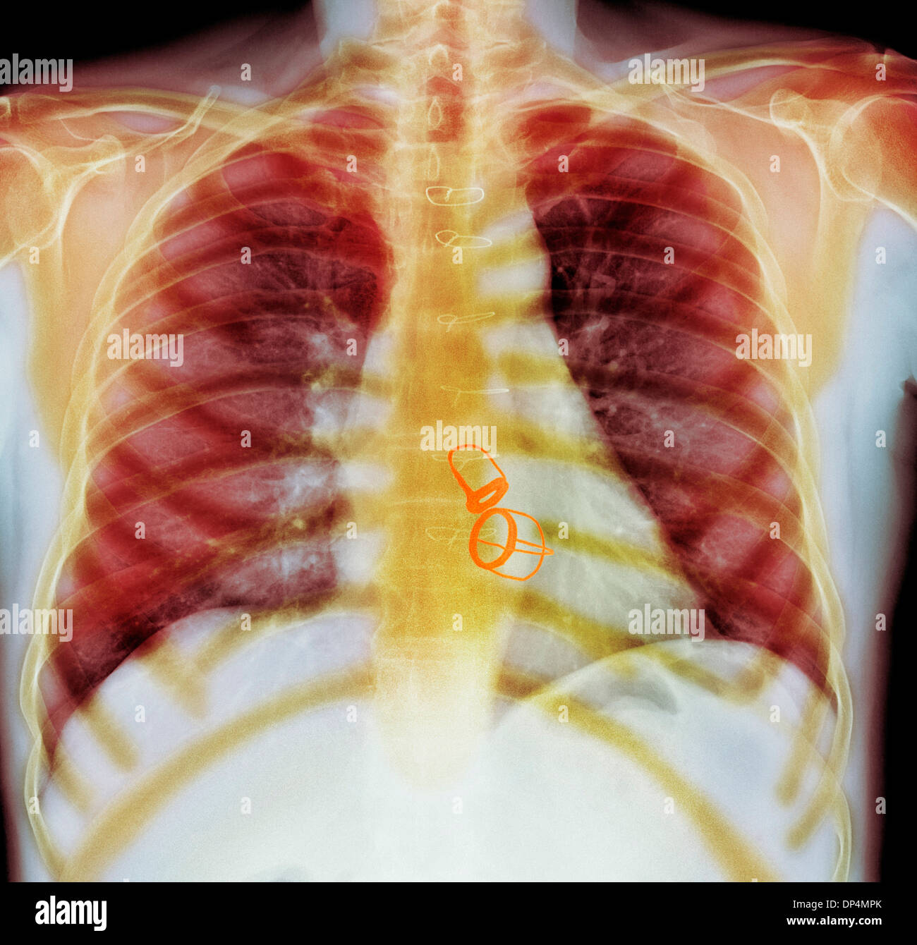 Valvole cardiache protesiche, X-ray Foto Stock