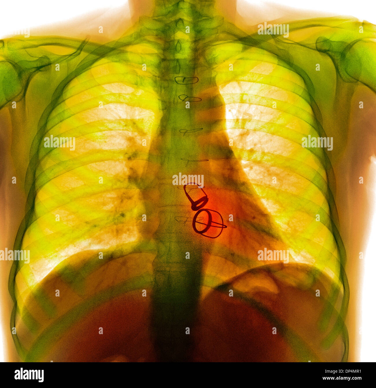 Valvole cardiache protesiche, X-ray Foto Stock