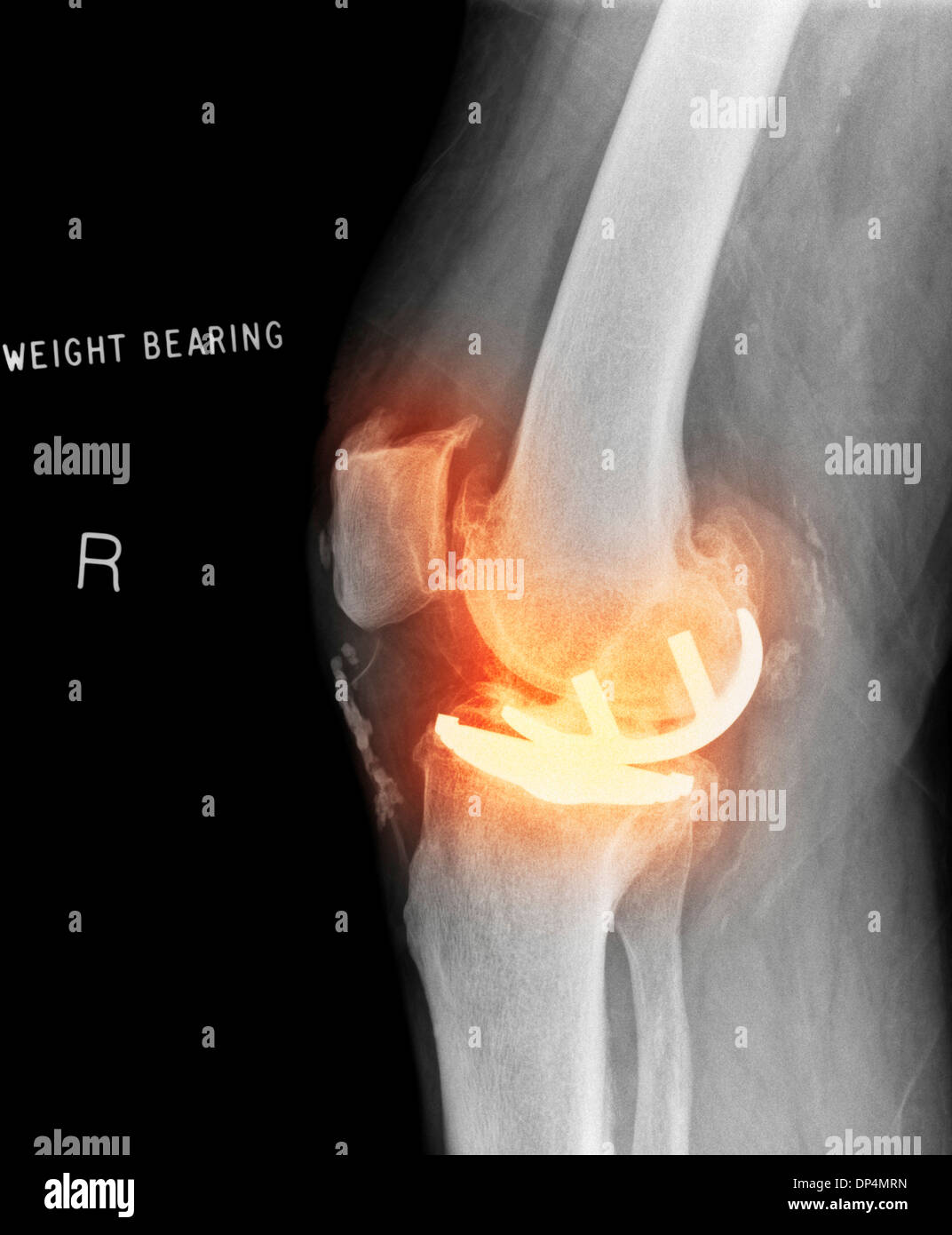 Osteoartrite del ginocchio, X-ray Foto Stock