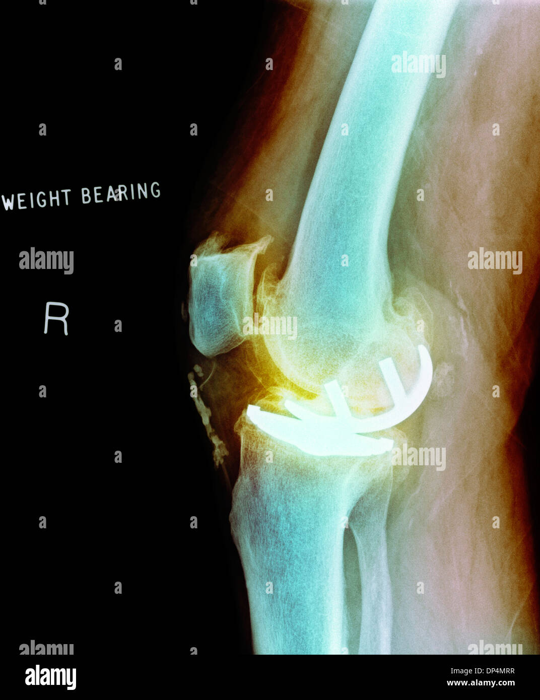 Osteoartrite del ginocchio, X-ray Foto Stock