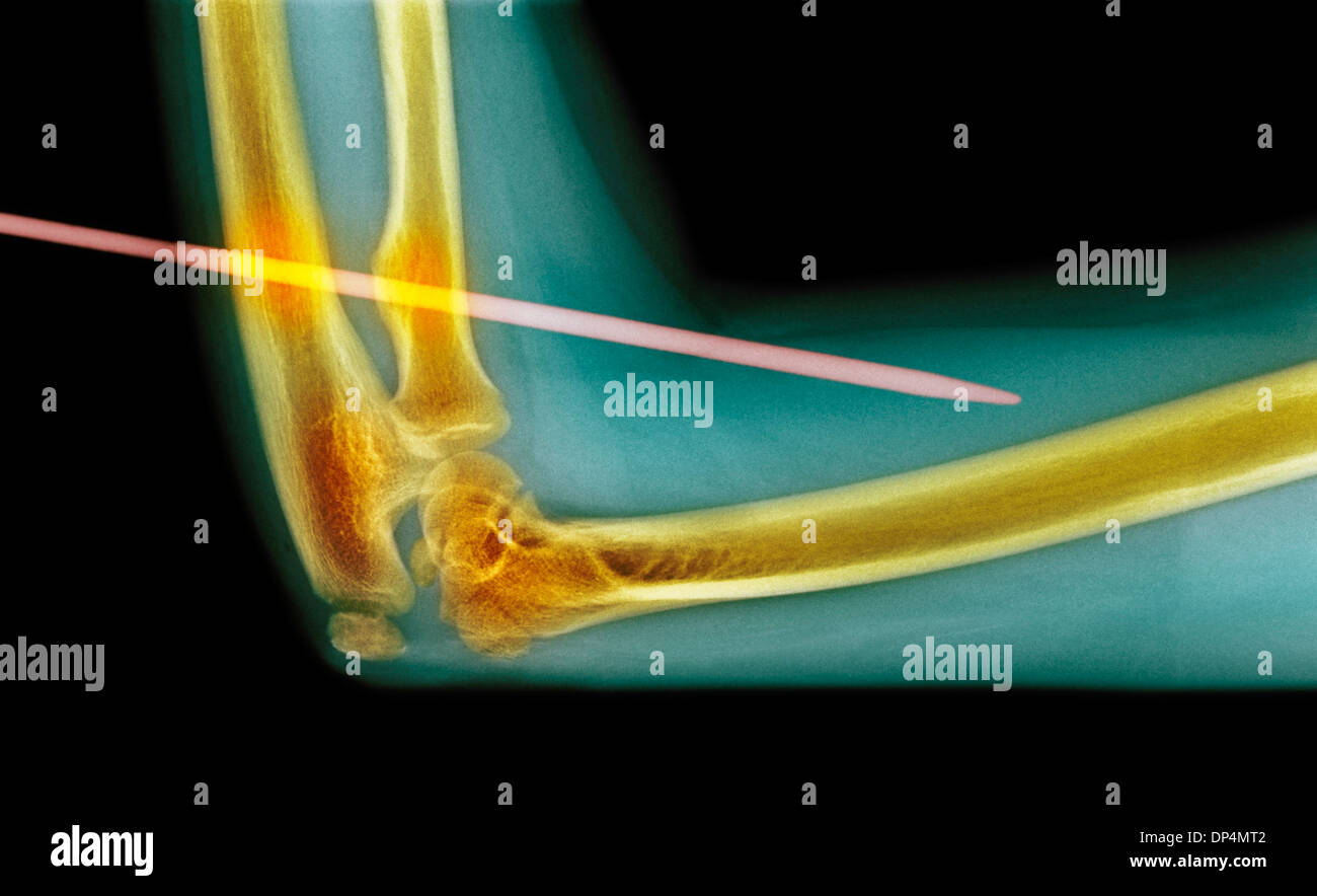 Ago da maglieria attraverso il braccio, X-ray Foto Stock