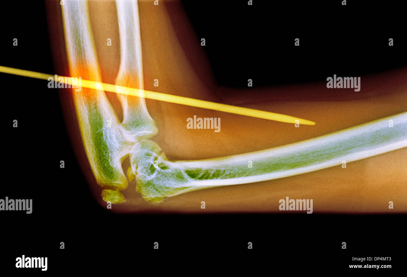 Ago da maglieria attraverso il braccio, X-ray Foto Stock
