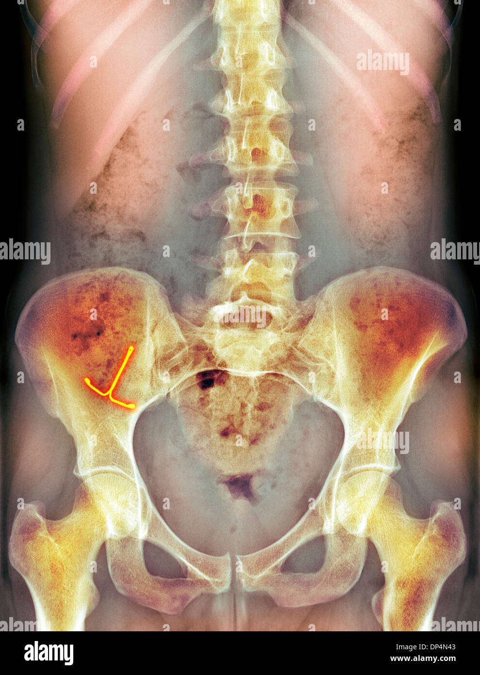 Ectopico contraccettivi IUD, X-ray Foto Stock
