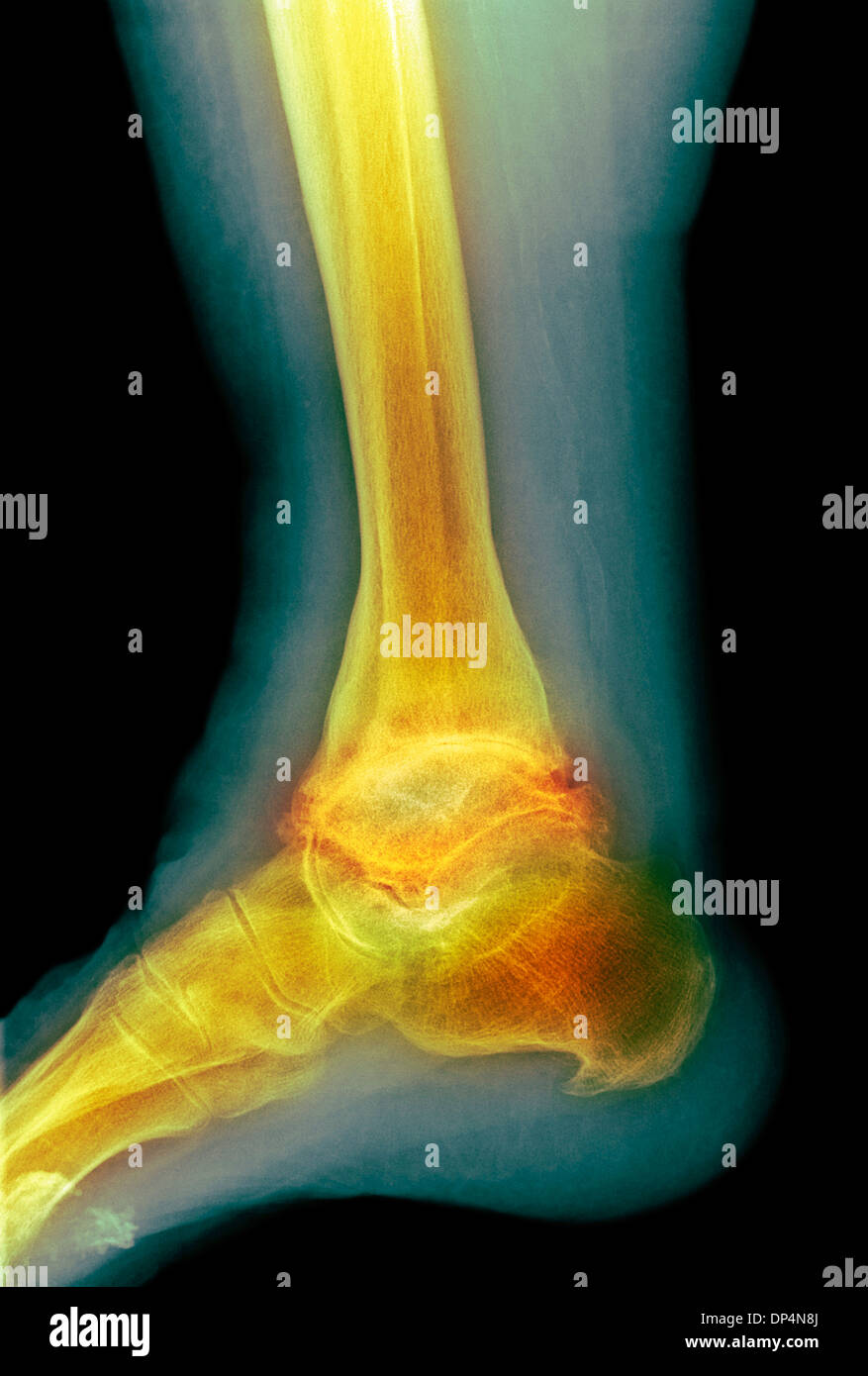 Artrosi della caviglia, X-ray Foto Stock