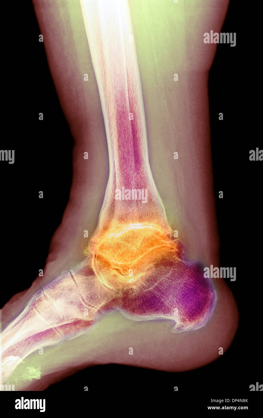 Artrosi della caviglia, X-ray Foto Stock