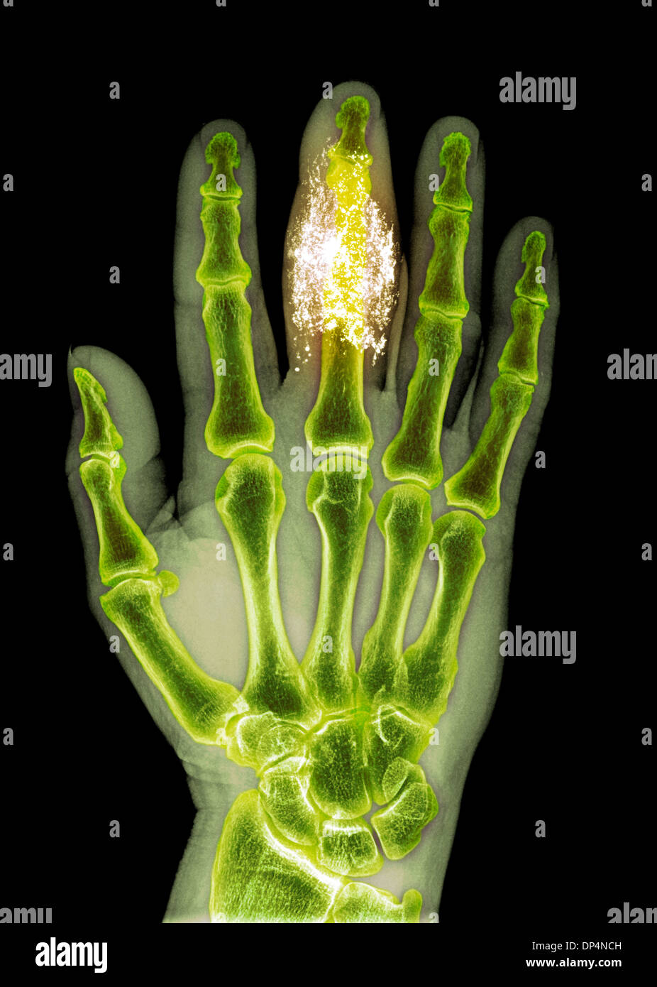 Corpo estraneo nel dito, X-ray Foto Stock