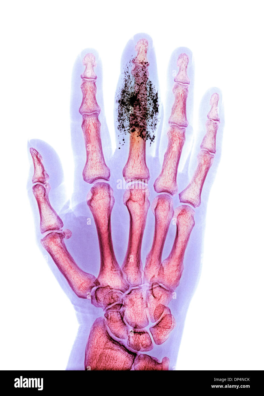 Corpo estraneo nel dito, X-ray Foto Stock
