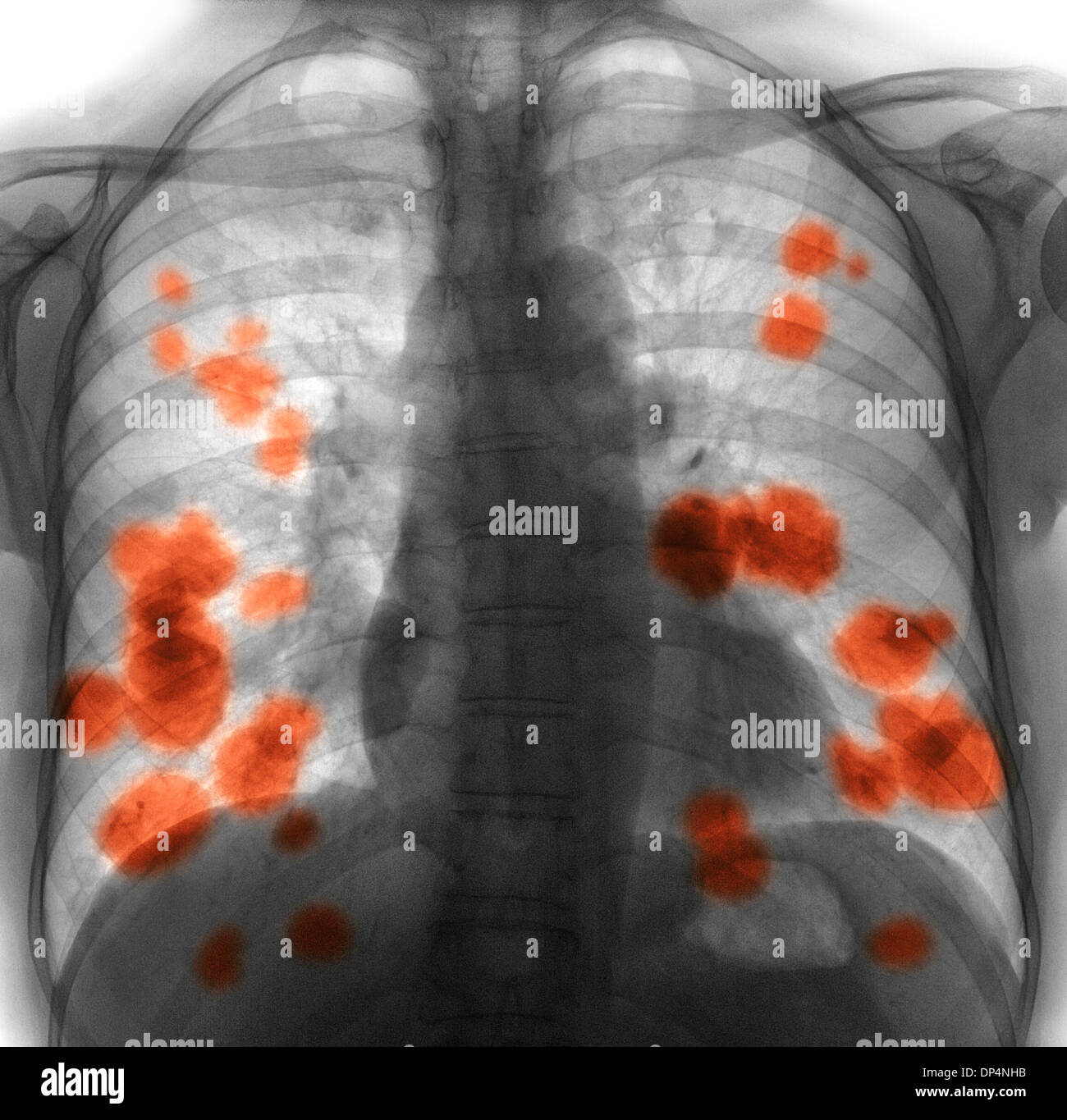 Secondaria di cancro ai polmoni, X-ray Foto Stock