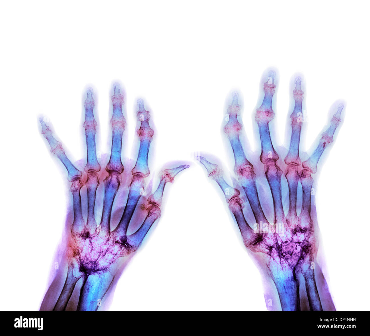 Artrite reumatoide, X-ray Foto Stock