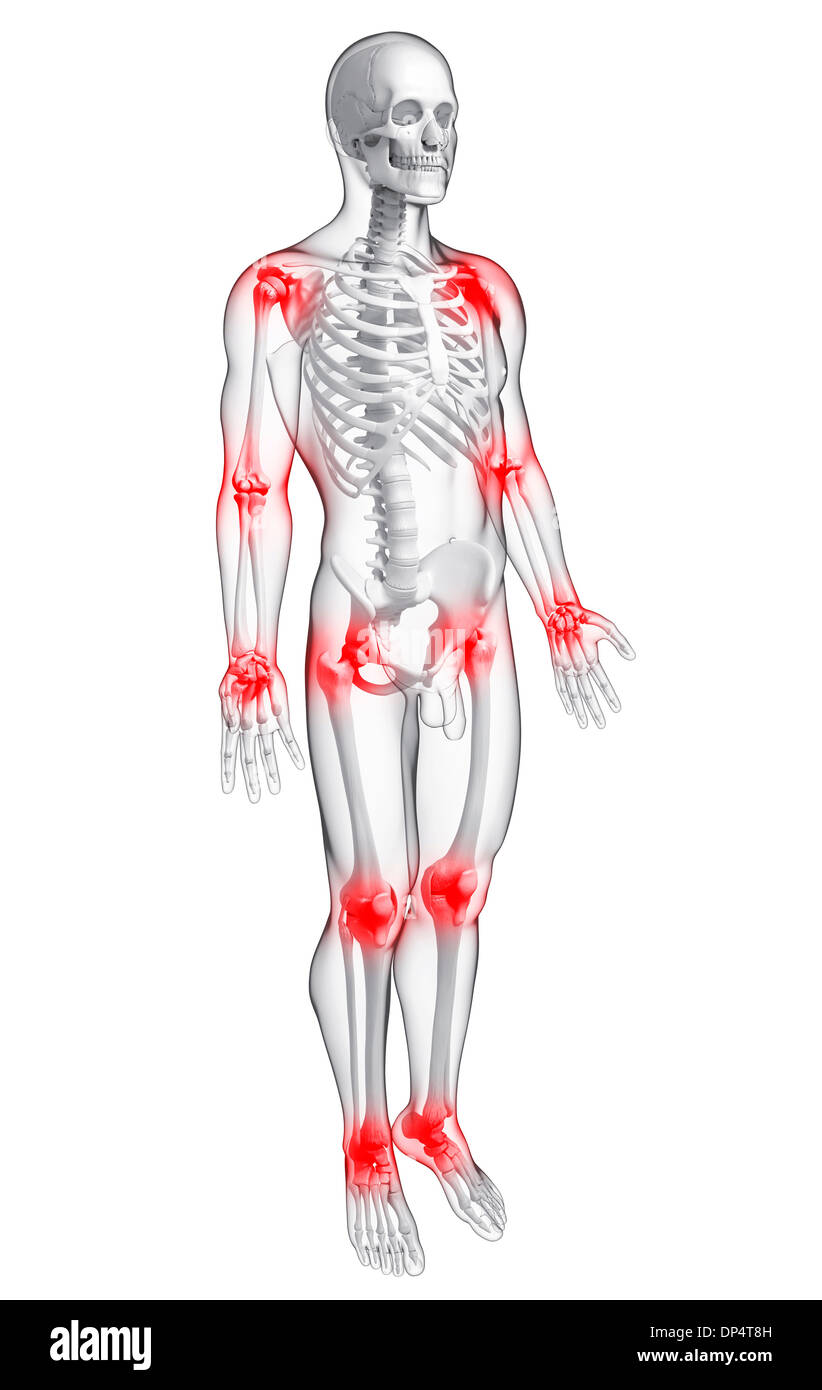 I dolori articolari, artwork Foto Stock