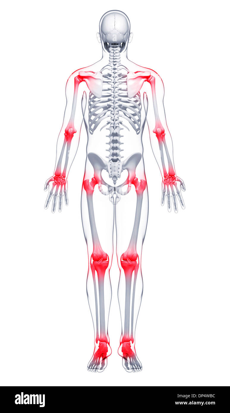 I dolori articolari, artwork Foto Stock