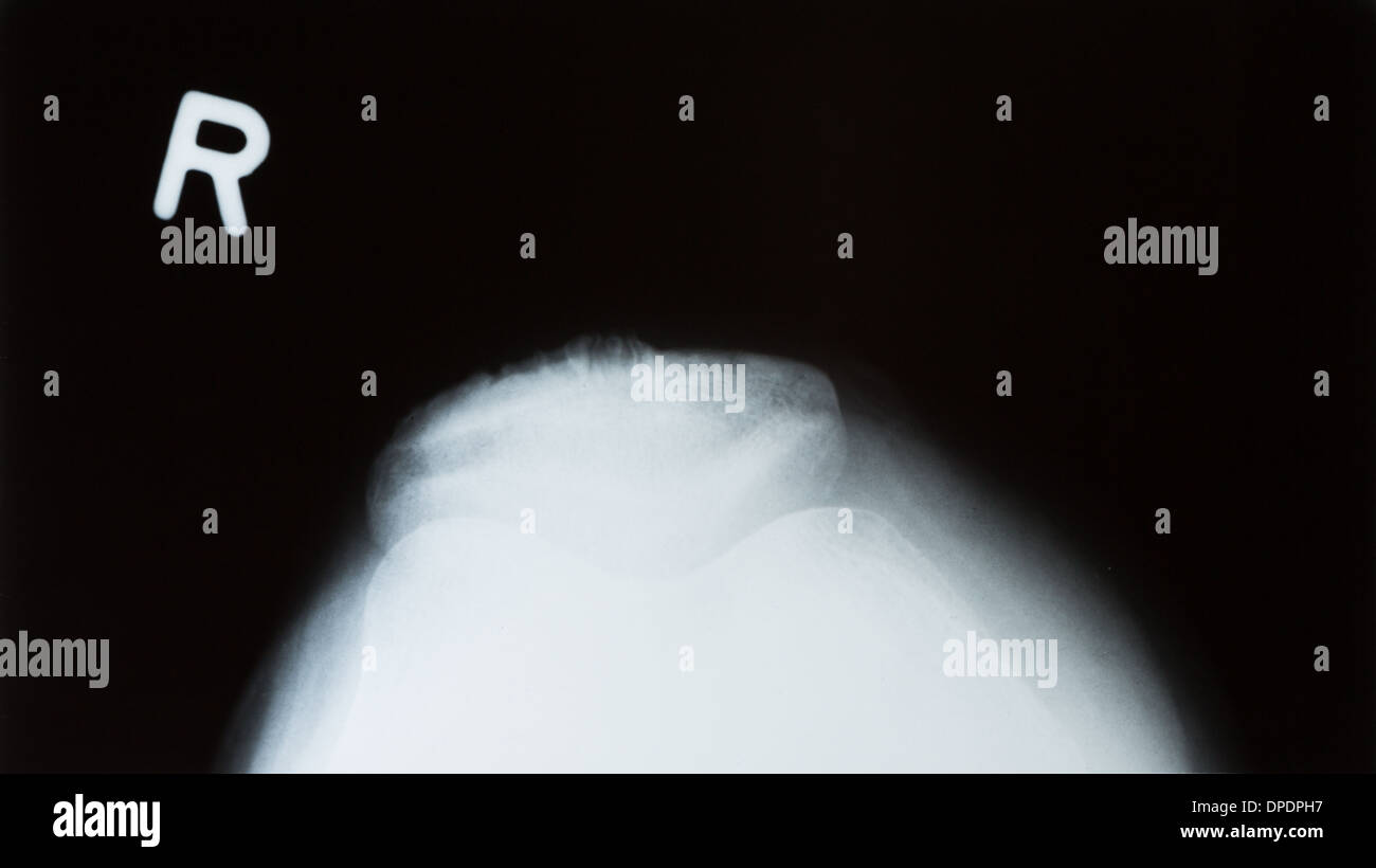 X-ray fotografia o roentgen l'immagine di un ginocchio umano con la tibia e femore, perone e rotula Foto Stock