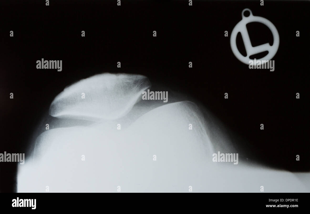 X-ray fotografia o roentgen l'immagine di un ginocchio umano con la tibia e femore, perone e rotula Foto Stock