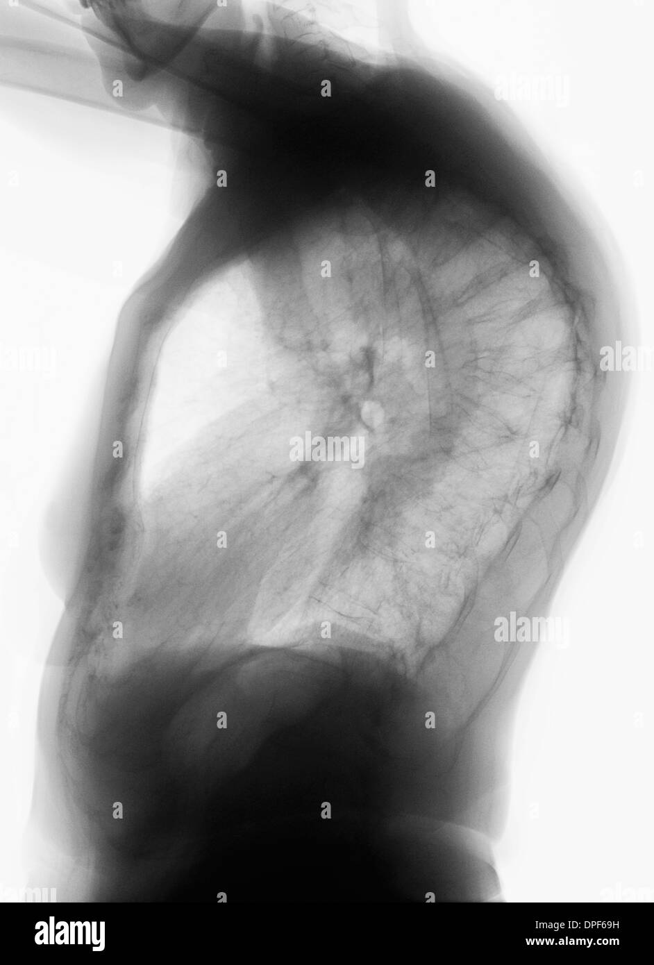 Scansione TC della colonna vertebrale che mostra la frattura di compressione Foto Stock