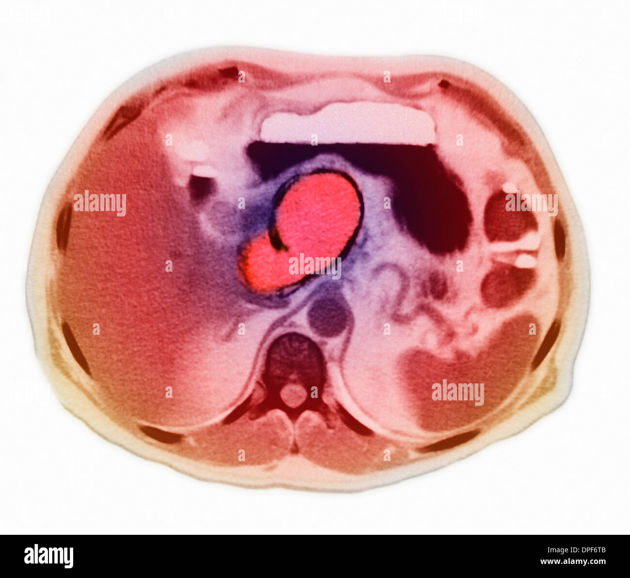 Pseudocyst pancreatica visto in MRI Foto Stock