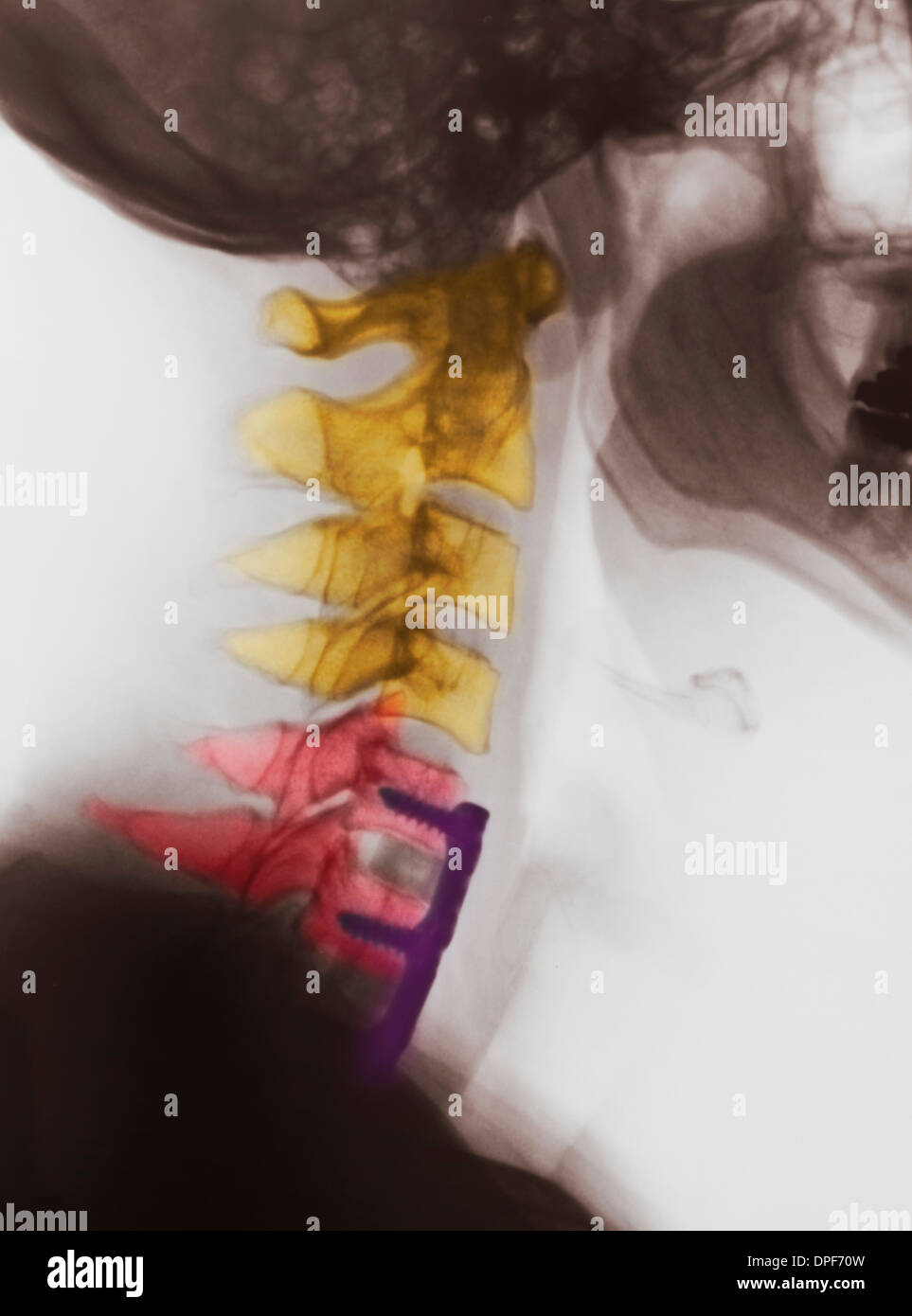 X-ray del collo che mostra la fusione spinale Foto Stock