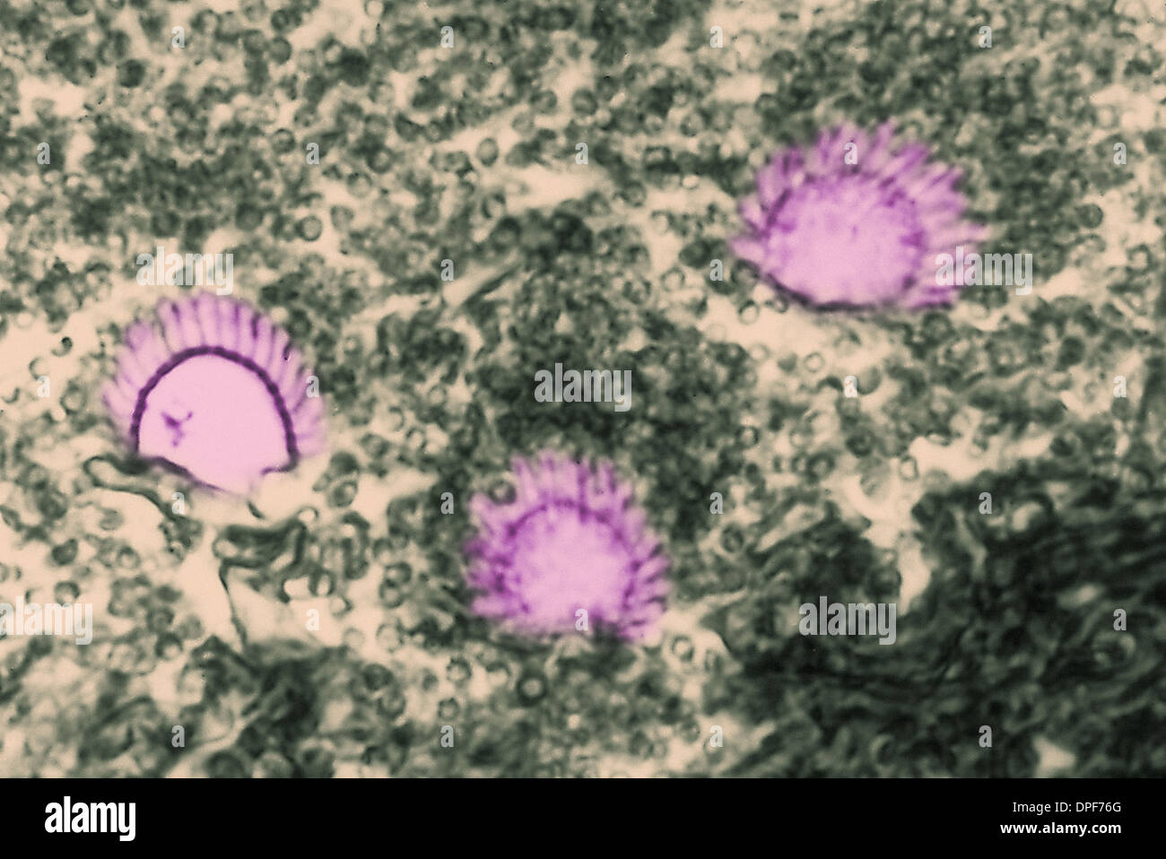 Micrografia luce di aspergillus polmonare Foto Stock