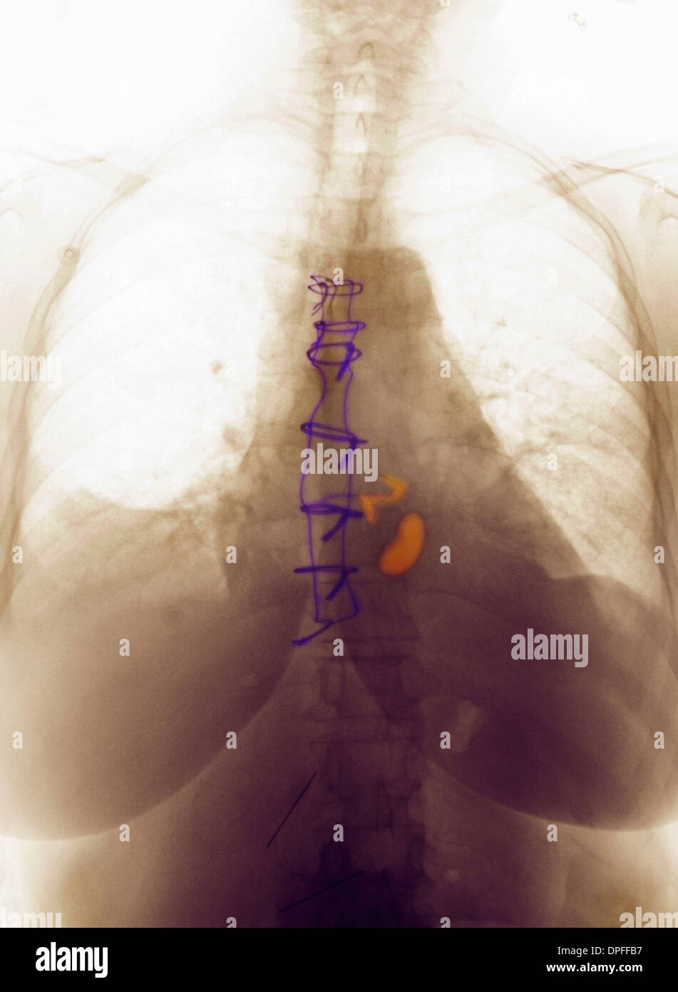 I raggi x al torace che mostra le valvole cardiache artificiali Foto Stock