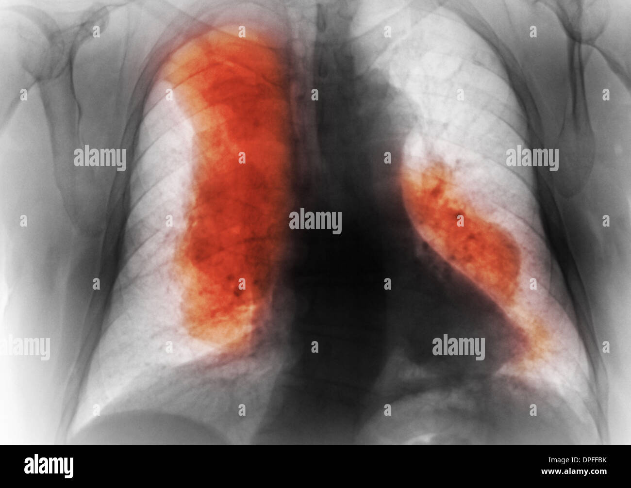 I raggi x al torace che mostra il linfoma cancro Foto Stock