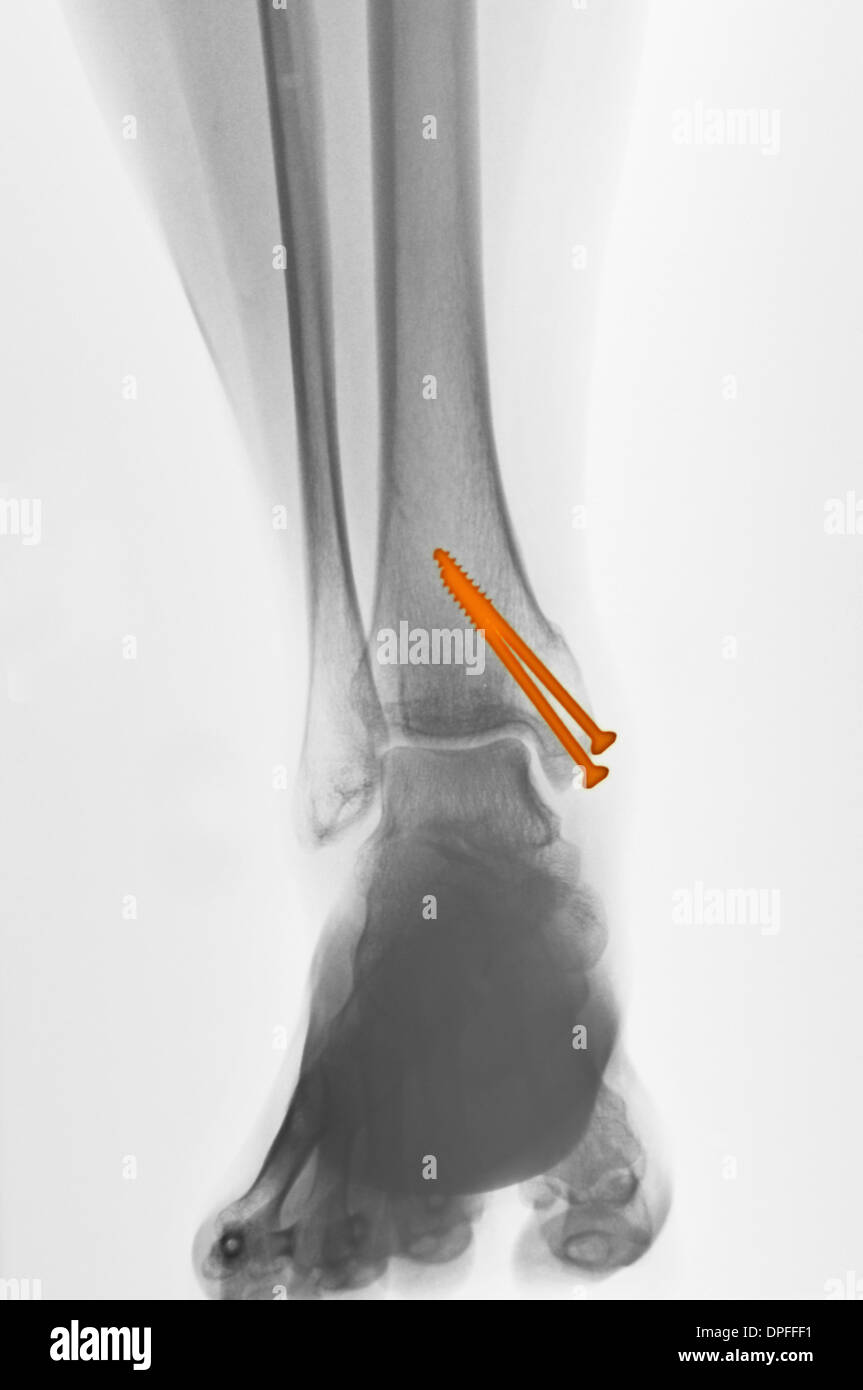 Raggi x di una caviglia frattura Foto Stock