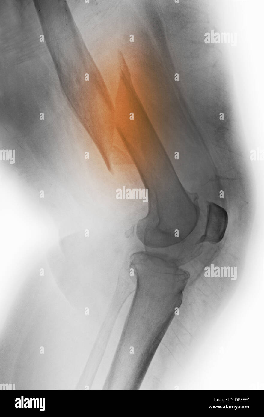 Raggi x di una frattura del femore Foto Stock